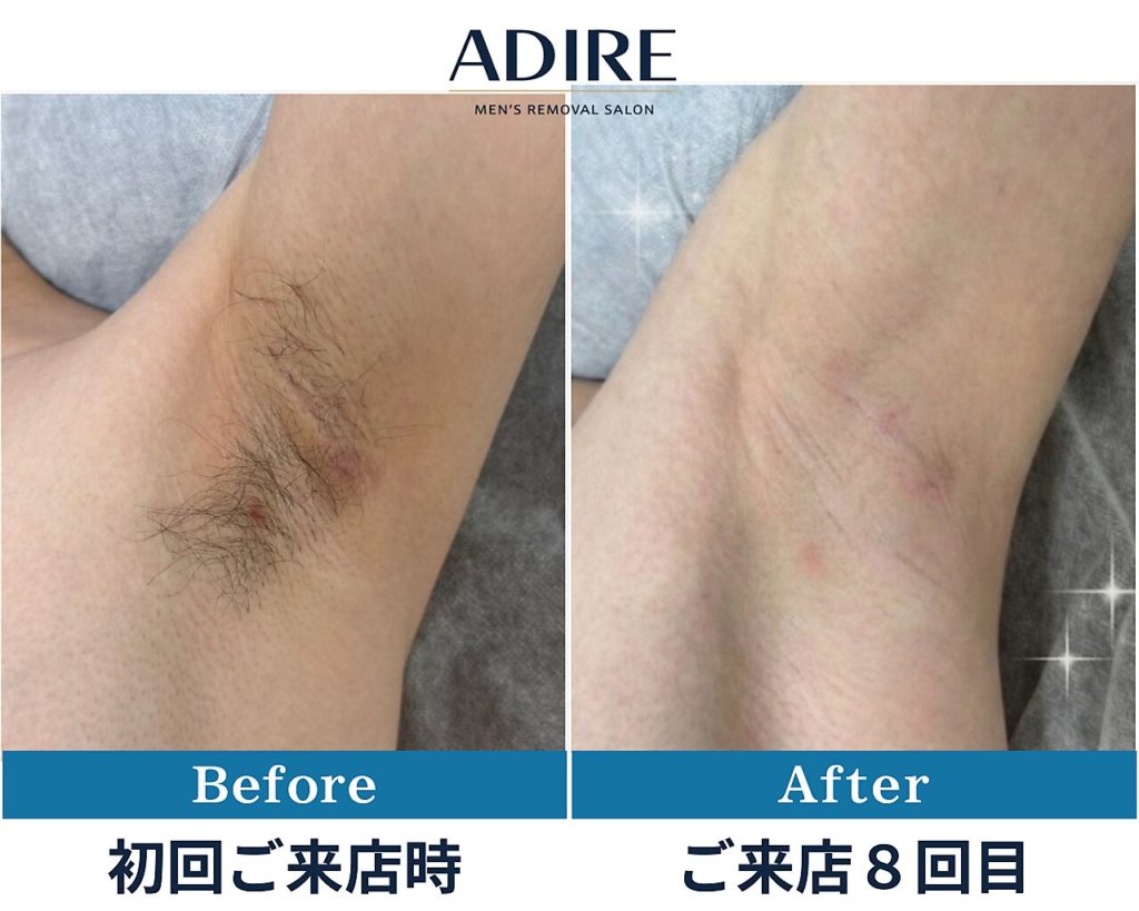 【ワキ脱毛】ビフォーアフター