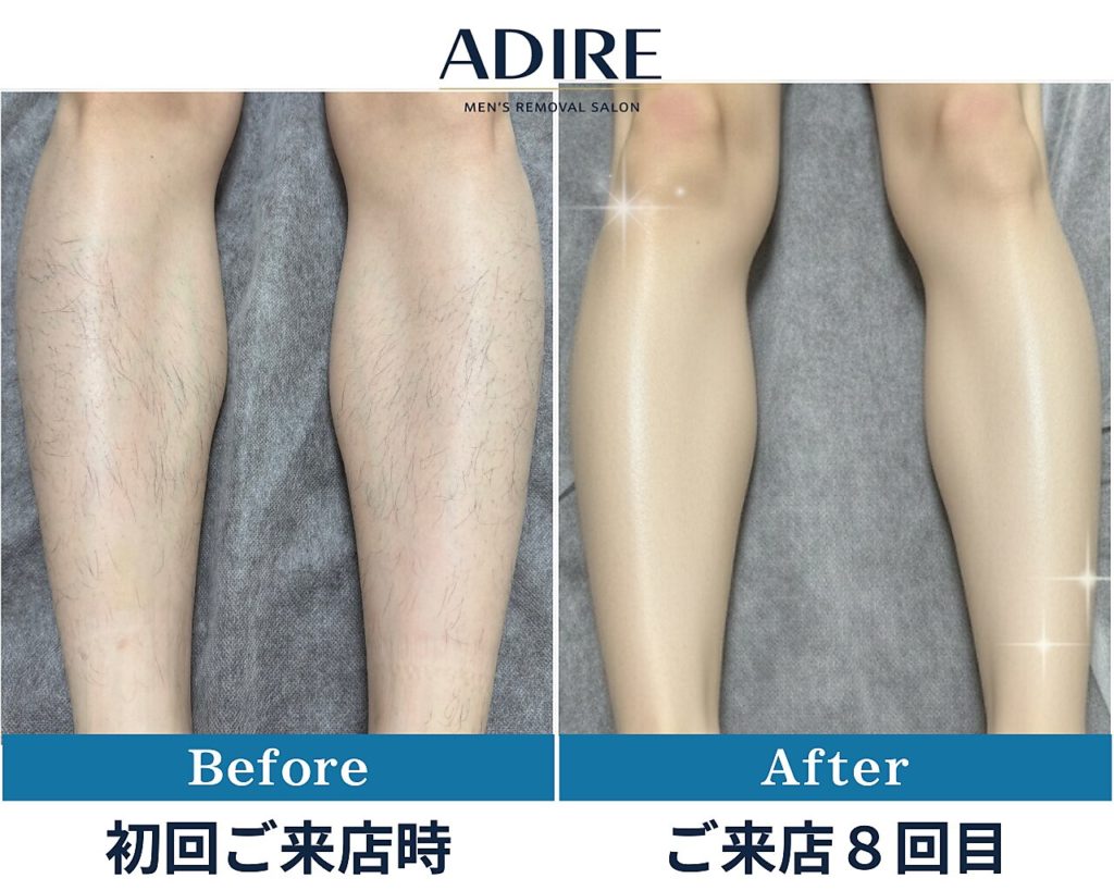 【足脱毛】ビフォーアフター