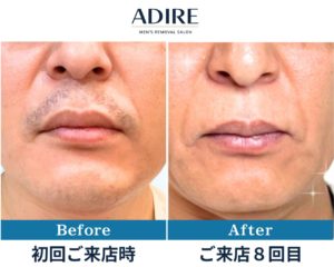 脱毛後、どのように毛が無くなっていきますか？